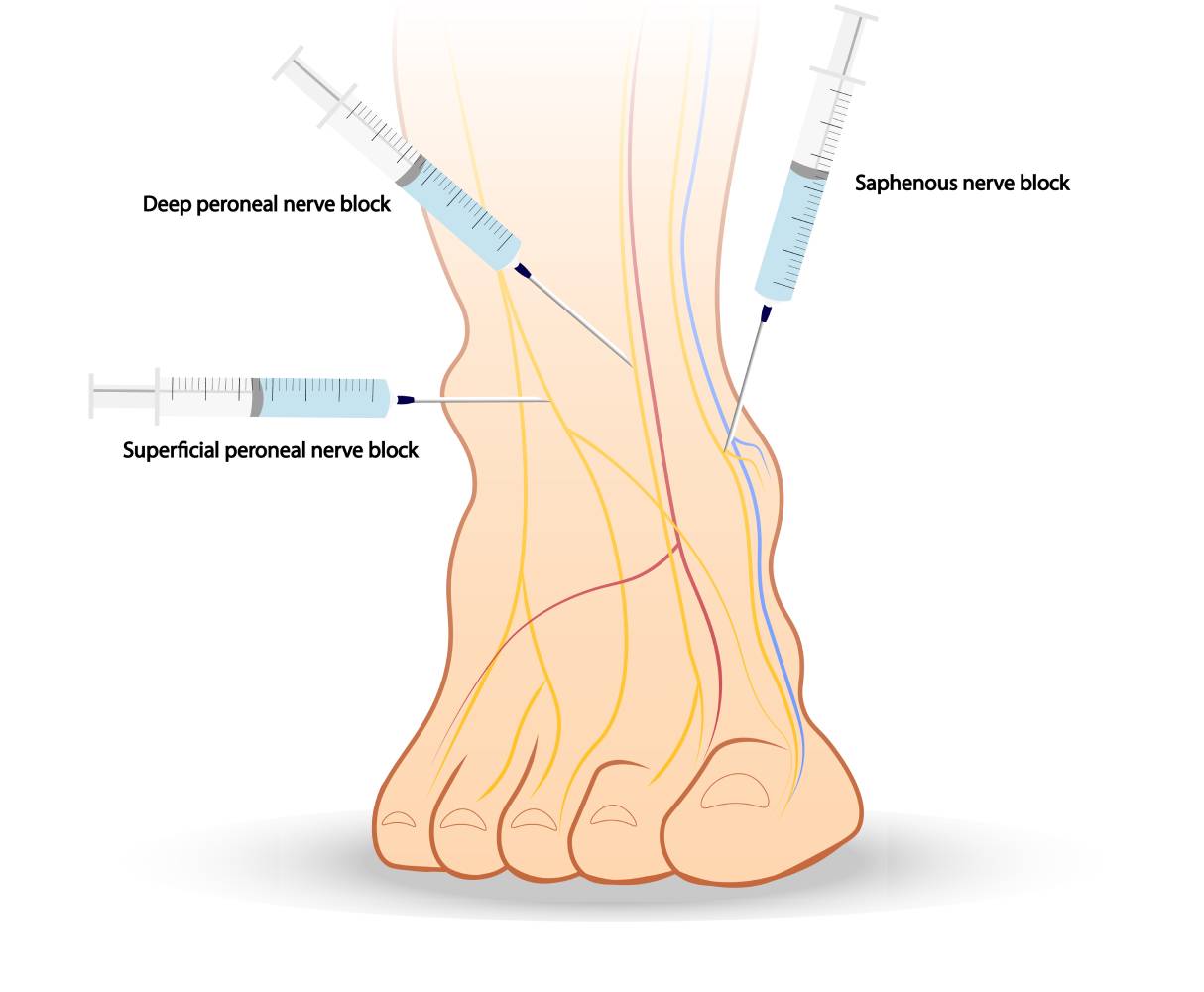 Reducing Opioid Use for Postoperative Pain Relief